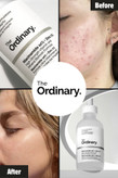 خرید The Ordinary niacinamide serum سرم کنترل چربی و ضد جوش
